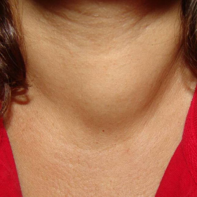 Quali sono i segni della malattia della tiroide nelle donne?