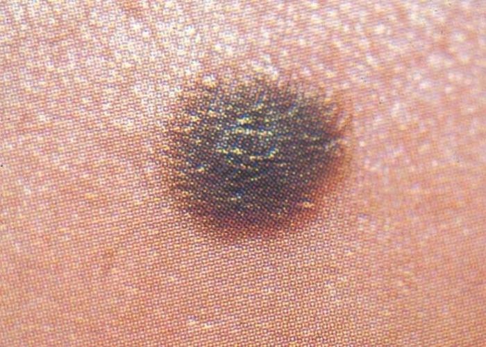 I principali segni di melanoma e le cause del melanoma