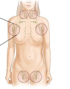 Perché i linfonodi all'inguine delle donne si infiammano?