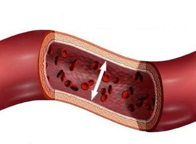 La vasculite è una lesione delle pareti dei vasi sanguigni